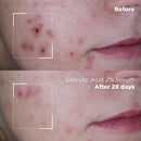 Oil Control & Anti-Spot Salicylic Acid 2% Serum