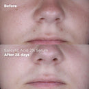 Oil Control & Anti-Spot Salicylic Acid 2% Serum